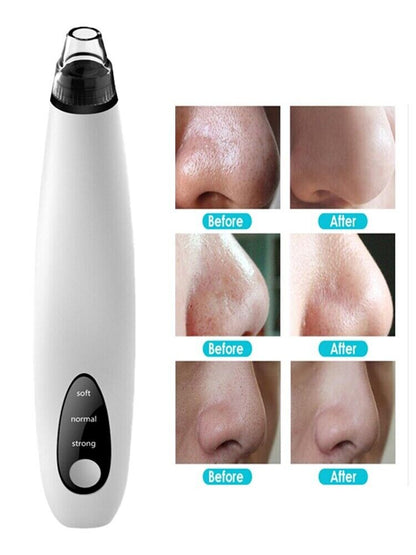 Electric Blackhead Remover & Pore Vacuum