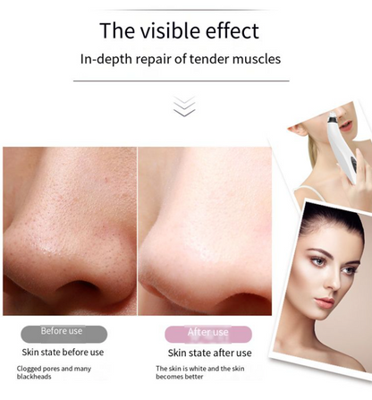 Electric Blackhead Remover & Pore Vacuum